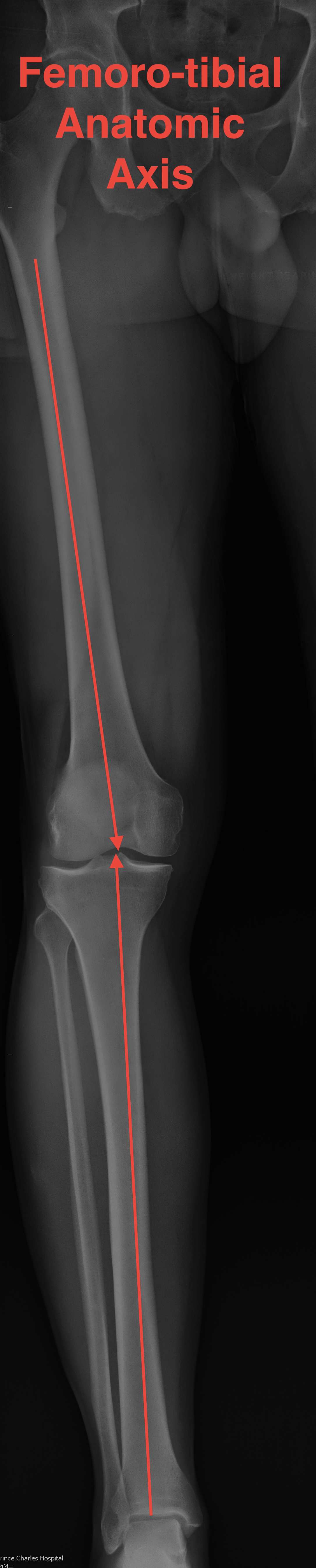 Tibio-femoral Anatomic Axis